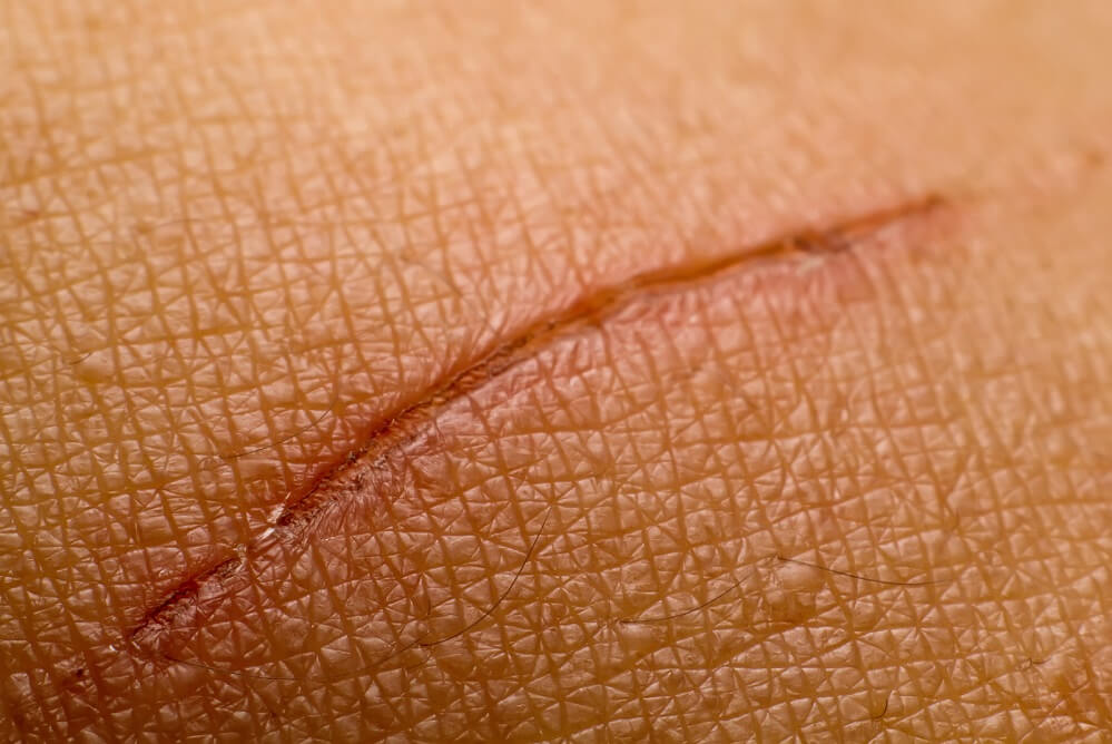 scar-on-skin OPT